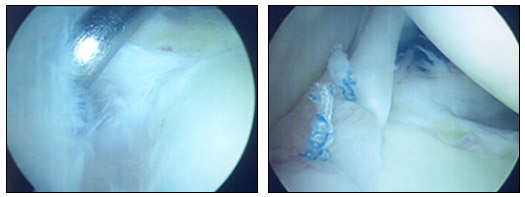 술전어깨 관절 SLAP병변 및 술후 관절경하 봉합술후 모습