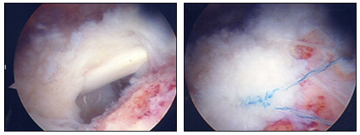 술전 어깨관절 회전근개 파열 모습 및 술후 관절경하 봉합술후 모습