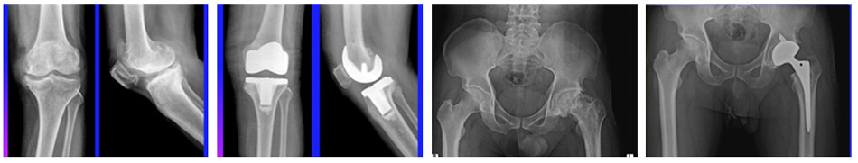 인공관절 수술전과 수술후의 모습